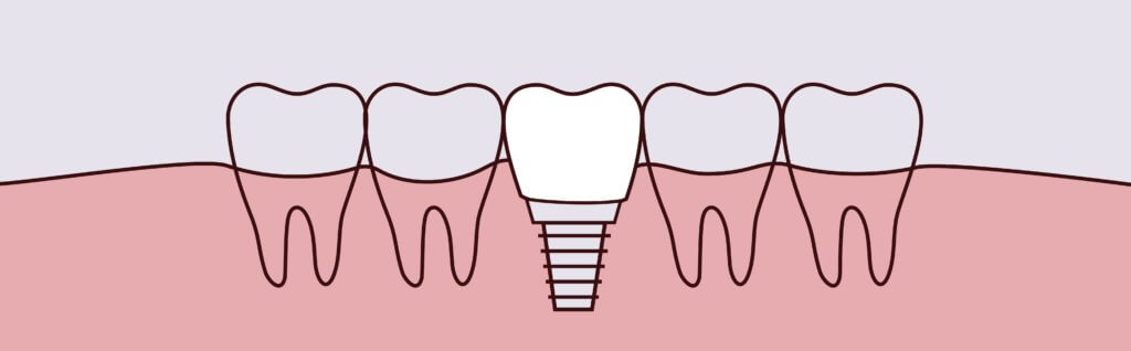 dental implants