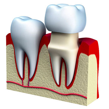 dental crowns vero beach dentist