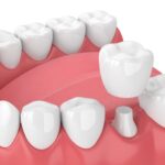 same-day crowns dentist in Vero Beach FL
