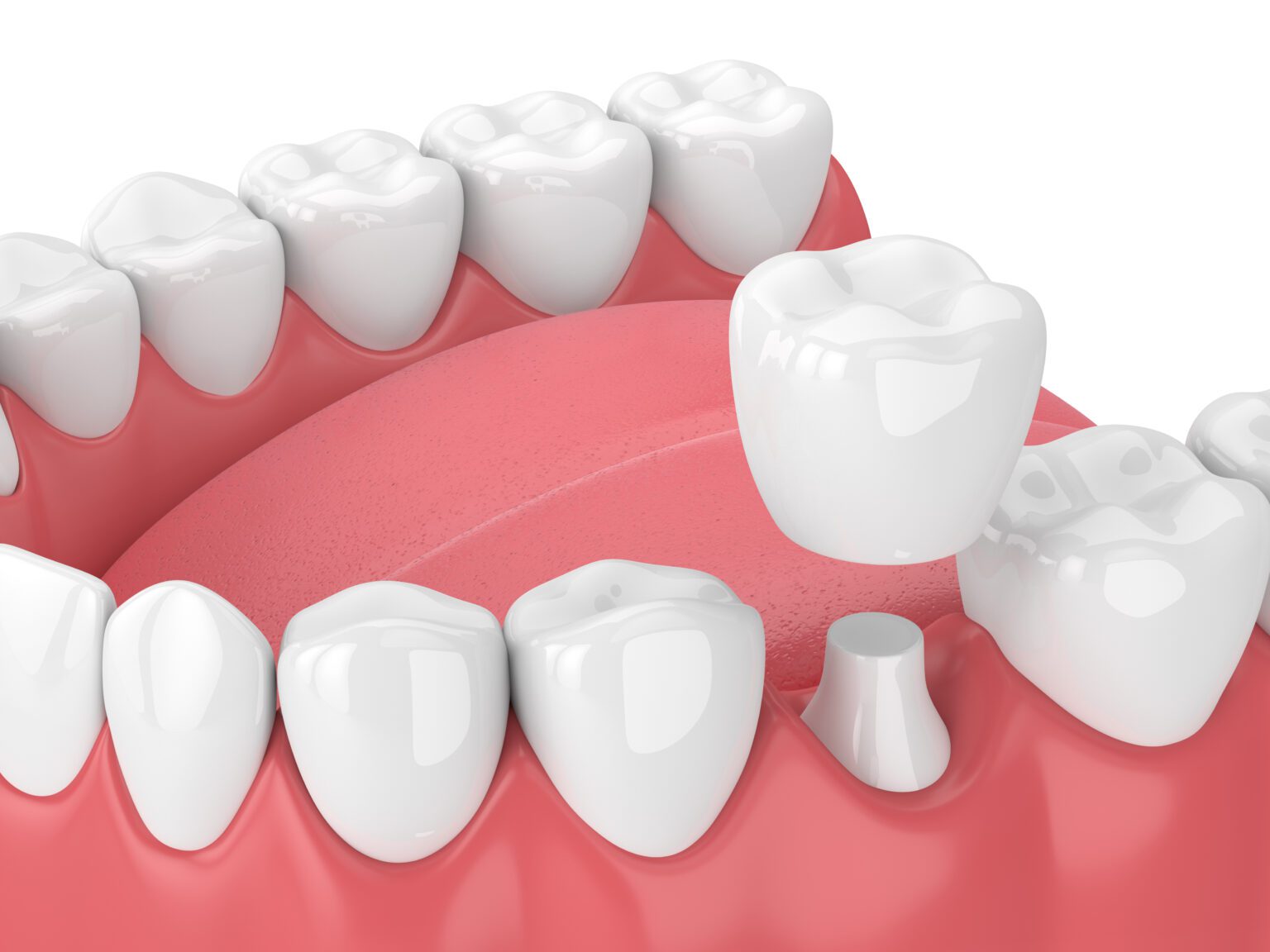 same-day crowns dentist in Vero Beach FL